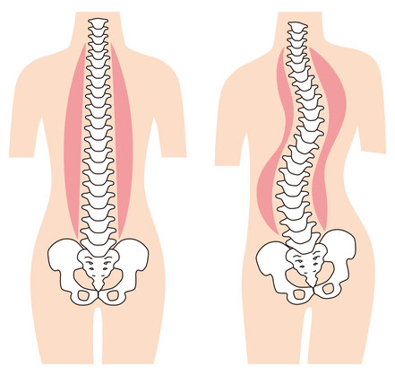Mikrosomie, Begleiterkrankung Skoliose